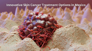 Innovative Skin Cancer Treatment Options in Mexico