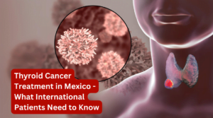 Thyroid Cancer Treatment in Mexico - What International Patients Need to Know