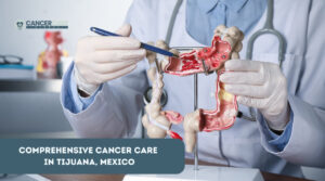 Immunotherapy for Colon Cancer Treatments in Tijuana, Mexico